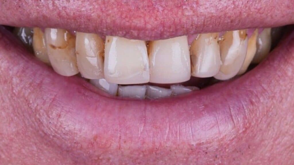 Sonrisa de un paciente antes del tratamiento