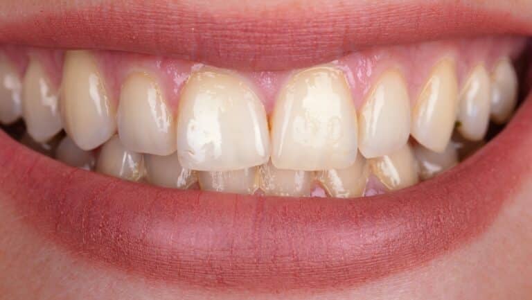 Sonrisa con los dientes amarillentos antes del blanqueamiento