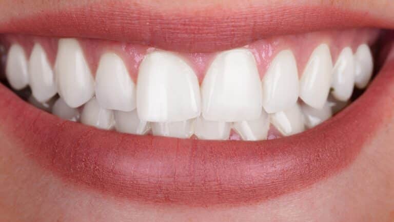 La misma sonrisa después del blanqueamiento dental