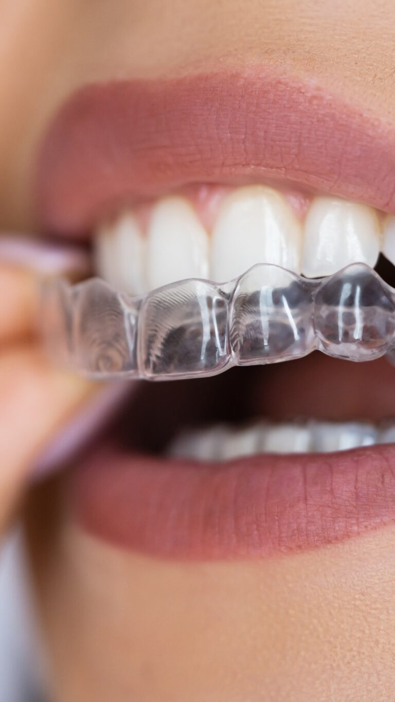 Alineador transparente colocado sobre los dientes