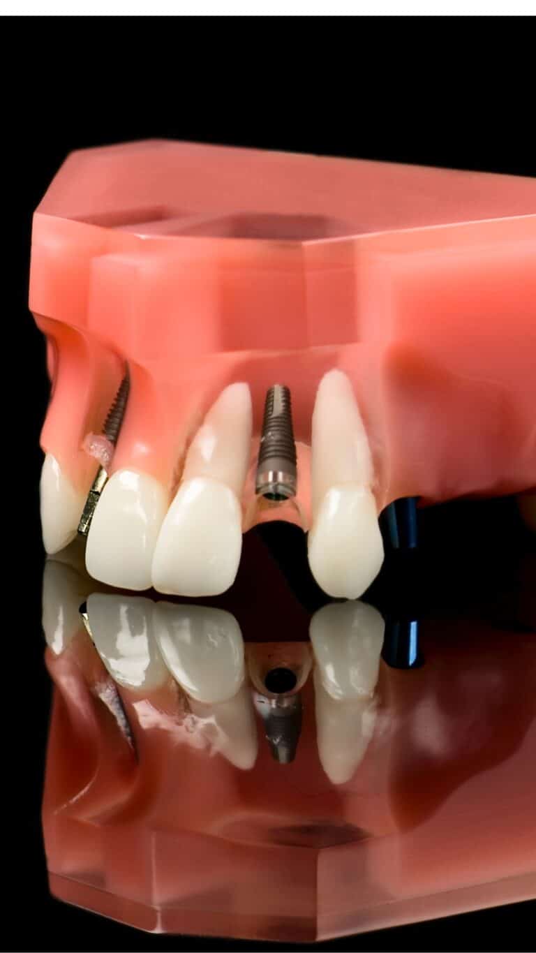 Maqueta de una arcada dental con implantes entre los dientes