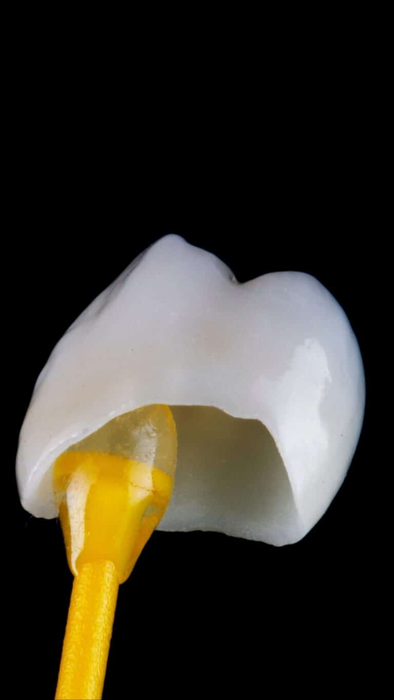 Corona dental de cerámica sujeta con un aplicador