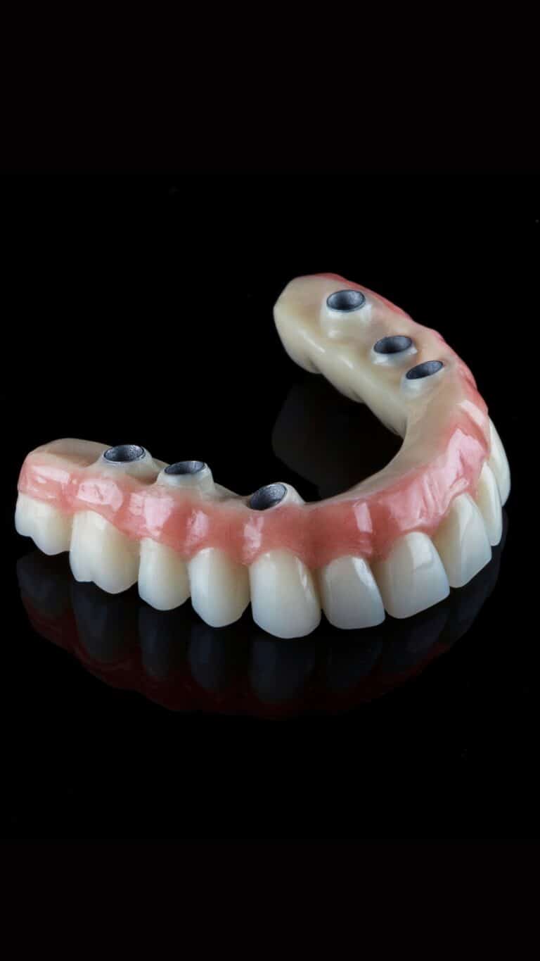 Prótesis dental completa atornillada sobre implantes, sobre fondo negro