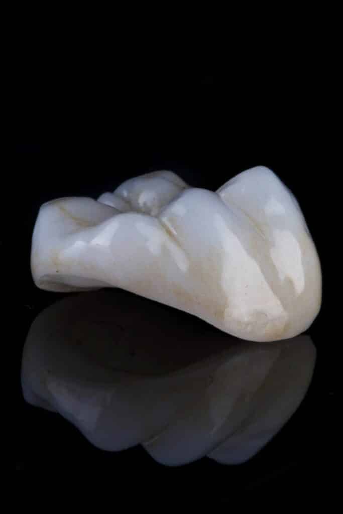 Restauración dental de cerámica
