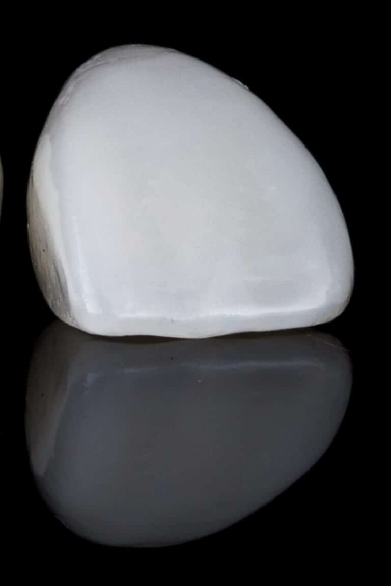 Carilla dental de cerámica